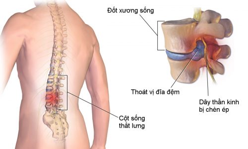 Cách Giảm Đau Lưng Tại Nhà Với Đai Treo Kéo Giãn Cột Sống 2 thoat vi dia dem 1